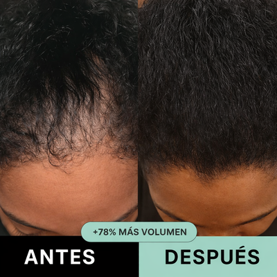 RenovaCapilar™ – Sistema de Micro-Infusión Capilar