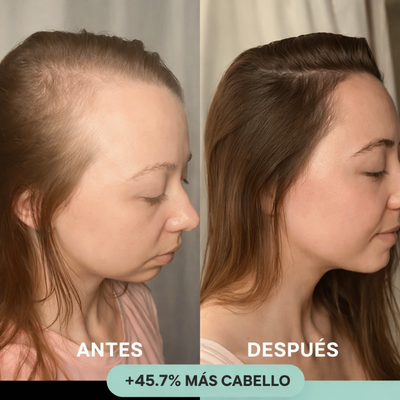 RenovaCapilar™ – Sistema de Micro-Infusión Capilar